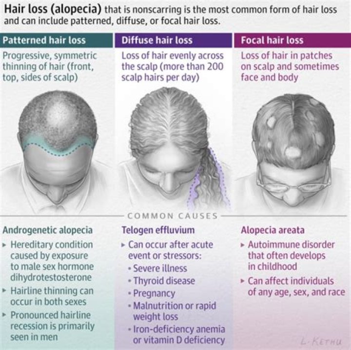 Alopecia Caused Massive Hair Loss