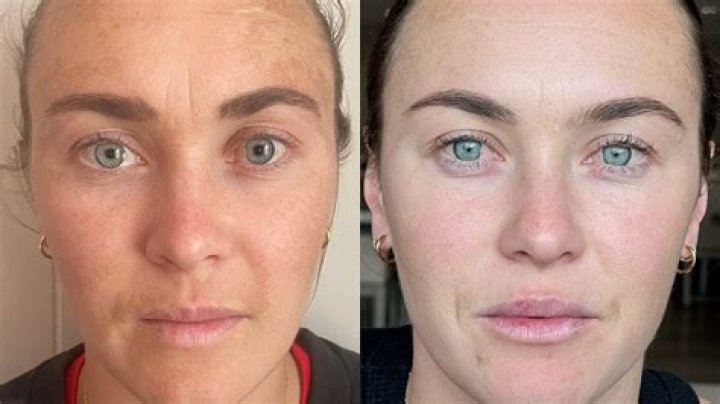 Caitlin Foord Skin Condition: Illness And Health 2023