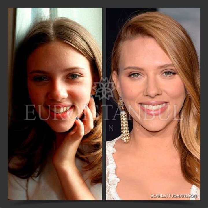 Has Scarlett Johansson Ever Undergone Plastic Surgery? Here's What We Know