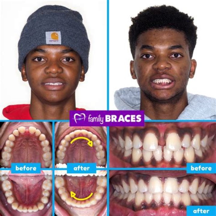 Josh Dobbs Teeth Before And After: Has He Used Braces?
