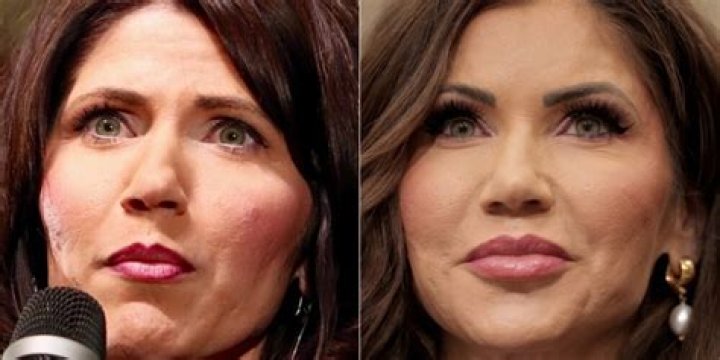 Michelle Heaton Plastic Surgery: Before And After Pictures